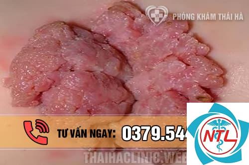 sùi mào gà tái phát - Image 3