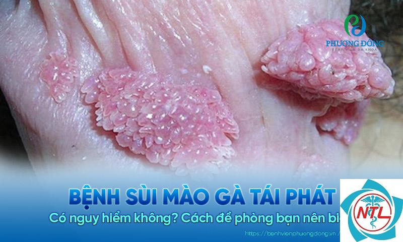 sùi mào gà tái phát - Image 4