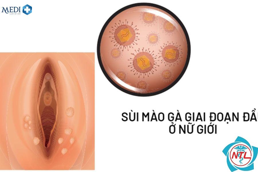 sùi mào gà vùng sinh dục - Image 4