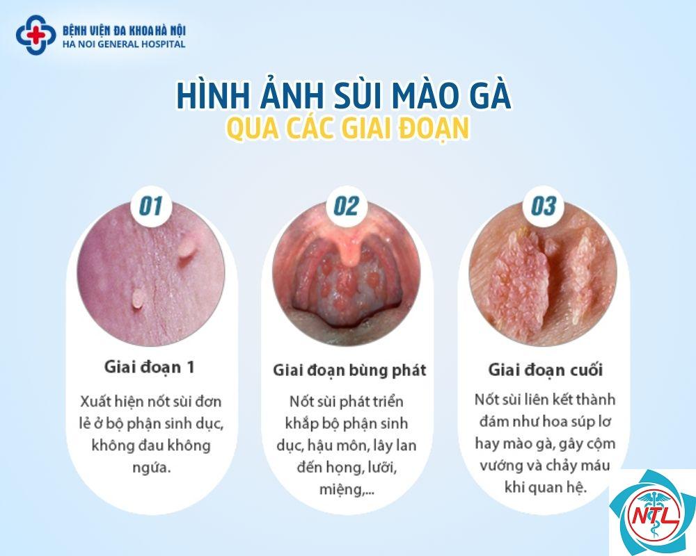 sùi mào gà vùng sinh dục - Image 5
