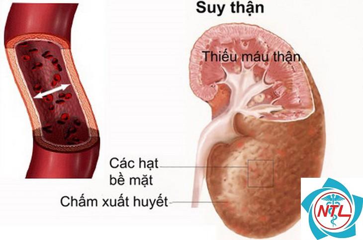 suy giảm chức năng thận - Image 3