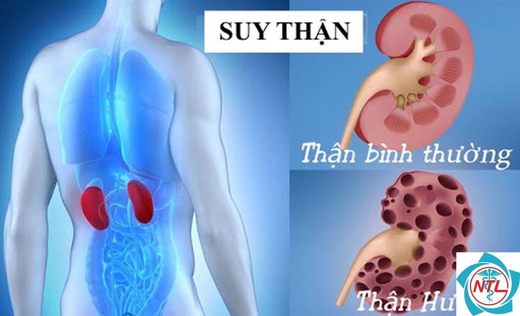 suy giảm chức năng thận - Image 5
