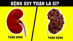 suy thận