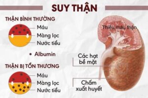suy thận cấp là gì