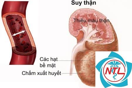 suy thận do bệnh cầu thận - Image 3