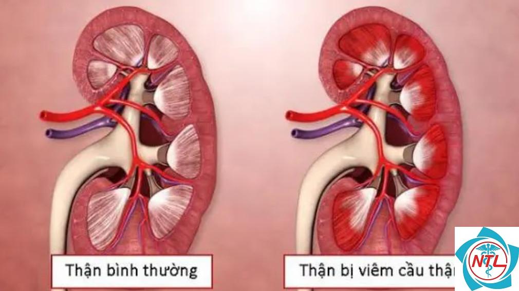 suy thận do bệnh cầu thận - Image 4