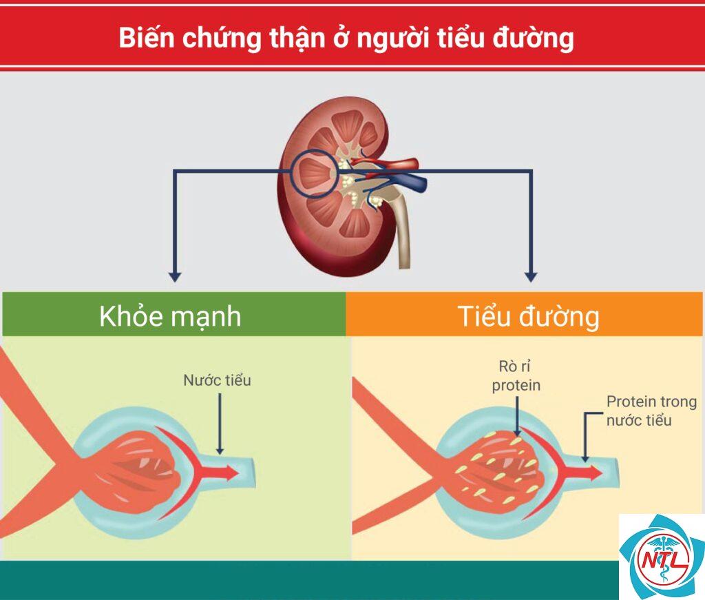 suy thận do đái tháo đường