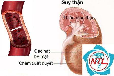 suy thận do mất nước - Image 2