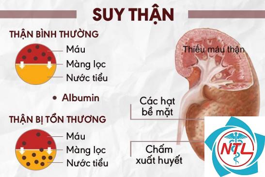 suy thận do mất nước - Image 5