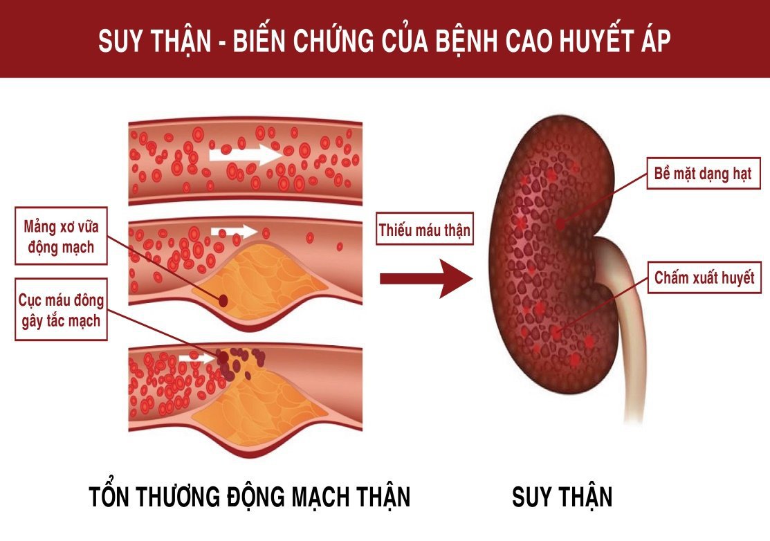 suy thận do tăng huyết áp - Image 2
