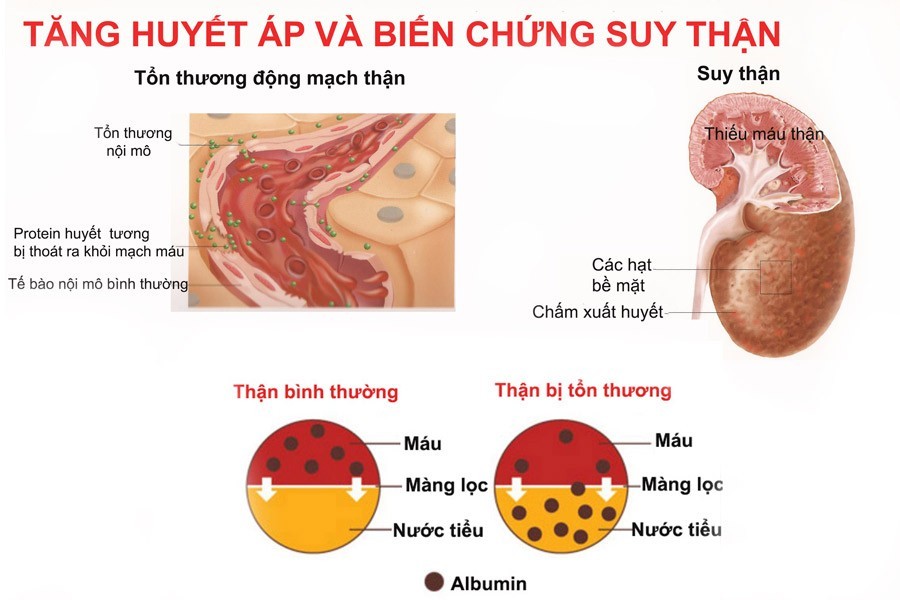 suy thận do tăng huyết áp - Image 3