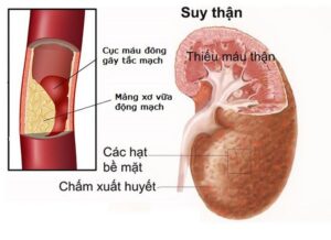 suy thận do tăng huyết áp