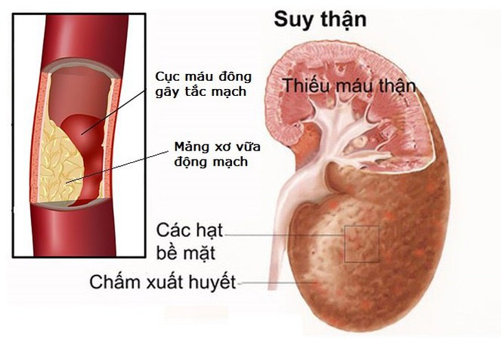 suy thận do tăng huyết áp