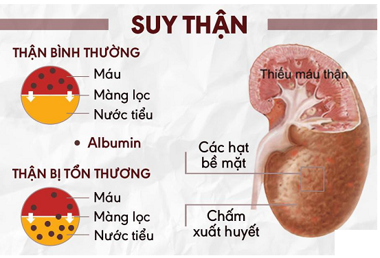 suy thận do tiểu đường - Image 3