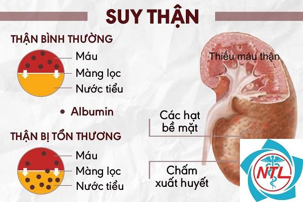 suy thận mạn - Image 4