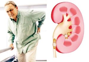 suy thận ở người cao tuổi
