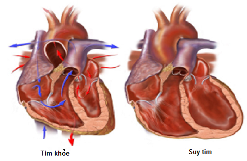 suy tim có nguy hiểm không - Image 4