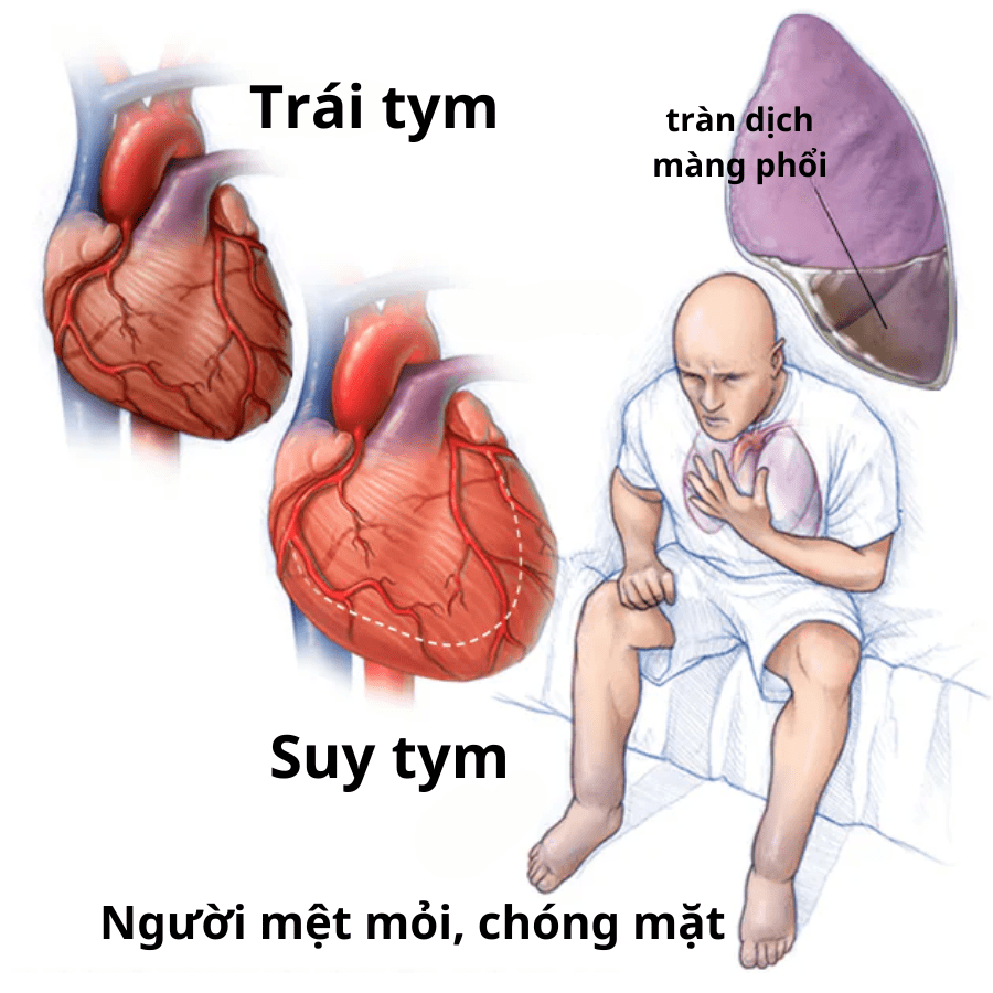 suy tim gây mệt mỏi - Image 3