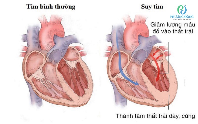 suy tim gây tăng cân nhanh - Image 4