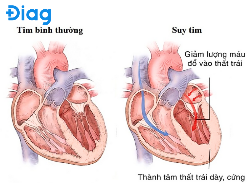 suy tim mất bù - Image 2