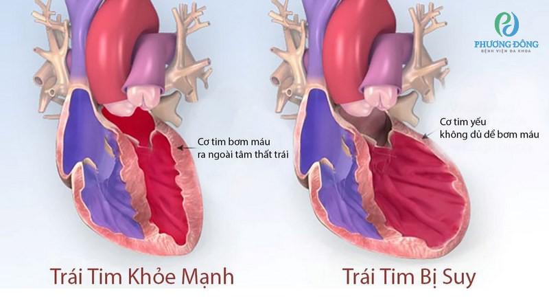 suy tim mất bù - Image 5