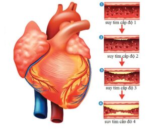 suy tim ở người cao tuổi