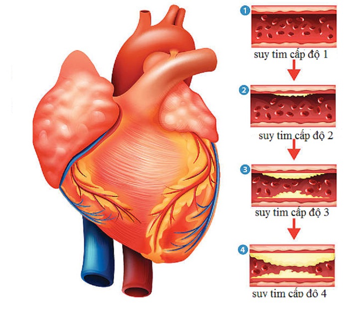 suy tim ở người cao tuổi