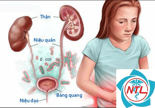 tắc nghẽn đường tiết niệu - Image 5