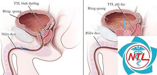 tắc nghẽn đường tiểu dưới - Image 2