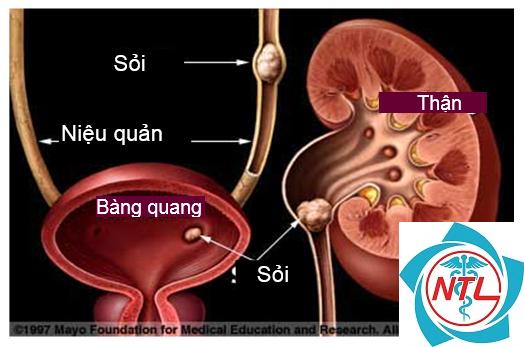 tắc nghẽn đường tiểu dưới - Image 3