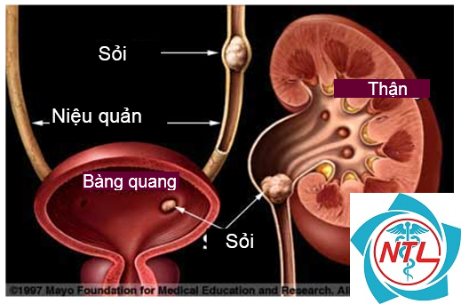 tắc nghẽn niệu đạo - Image 2