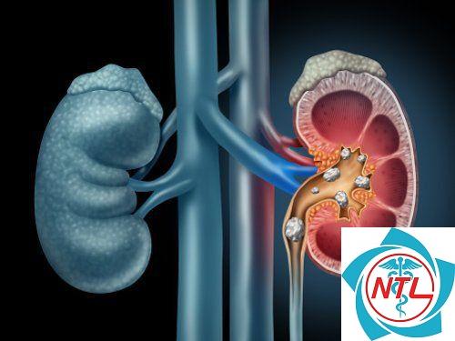tắc nghẽn niệu đạo - Image 3