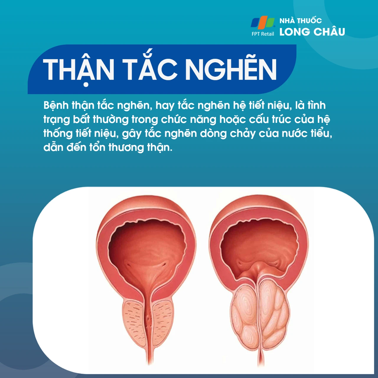 tắc nghẽn niệu đạo - Image 5