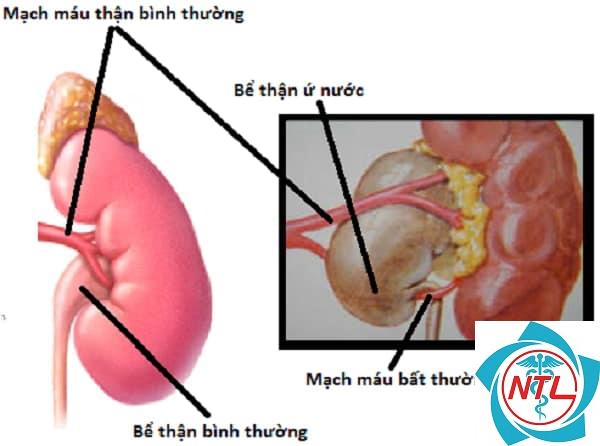 tắc nghẽn niệu quản - Image 3