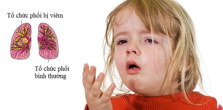tái khám sau viêm phổi - Image 2