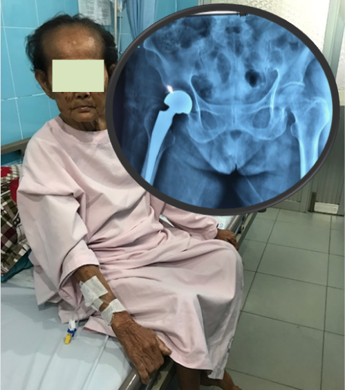 tai nạn gãy cu - Image 4