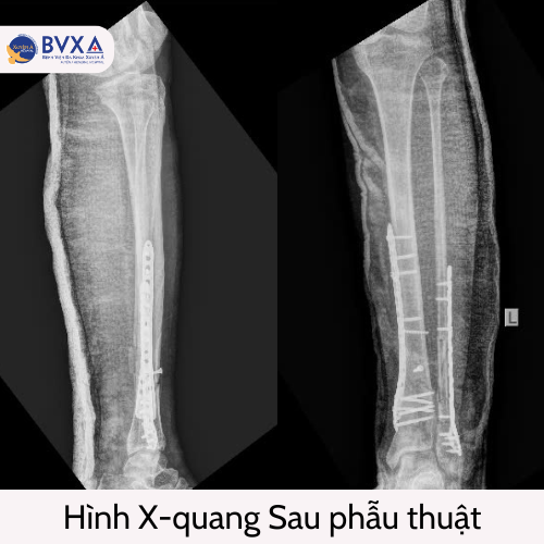 tai nạn gãy xương - Image 2
