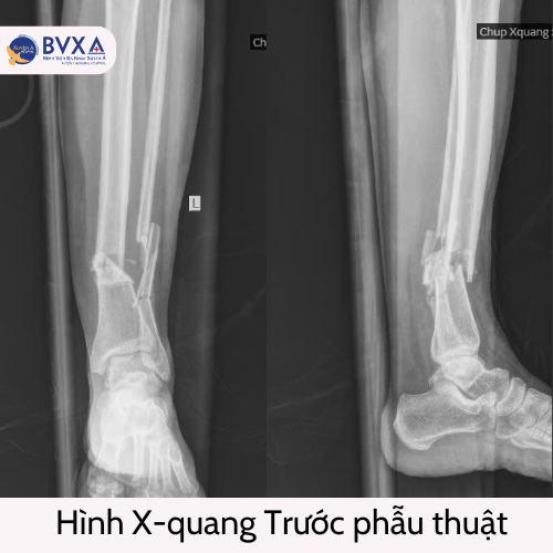 tai nạn gãy xương - Image 4
