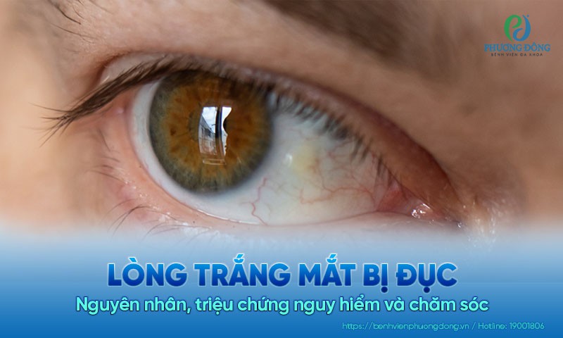 tại sao tròng trắng mắt bị đục - Image 3