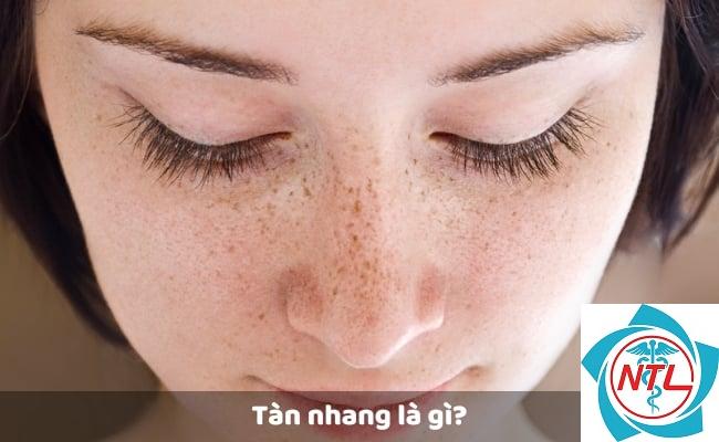 tàn nhang do ánh nắng - Image 5