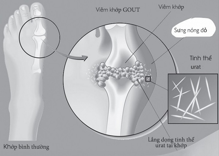 tăng acid uric ở người cao tuổi - Image 5