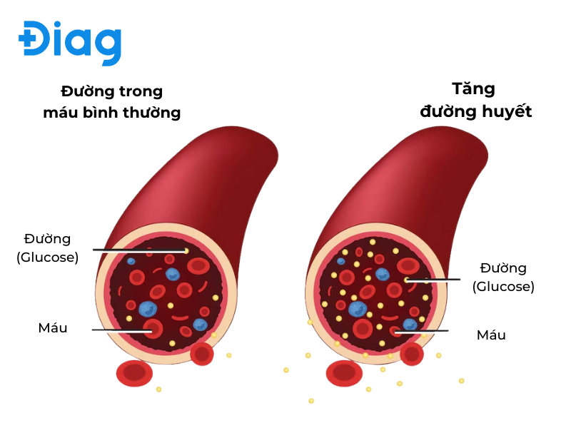 tăng đường huyết - Image 4