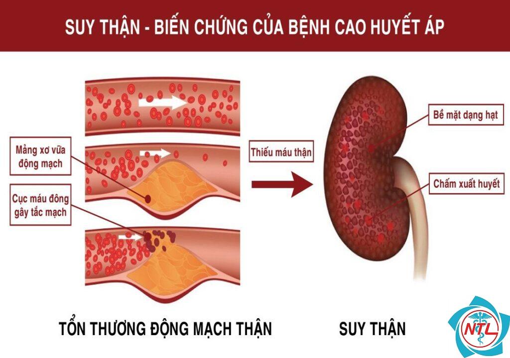 tăng huyết áp do bệnh thận