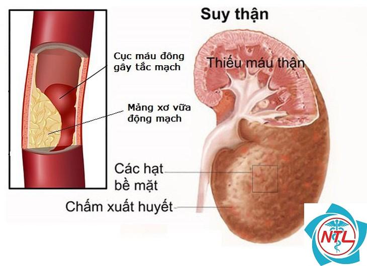 tăng huyết áp do bệnh thận - Image 2