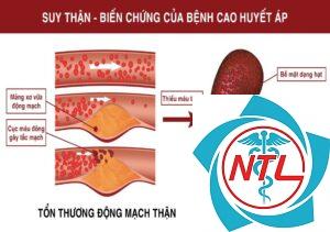 tăng huyết áp do bệnh thận