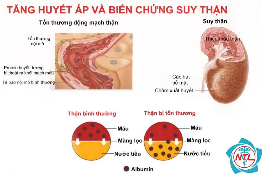 tăng huyết áp do bệnh thận - Image 4