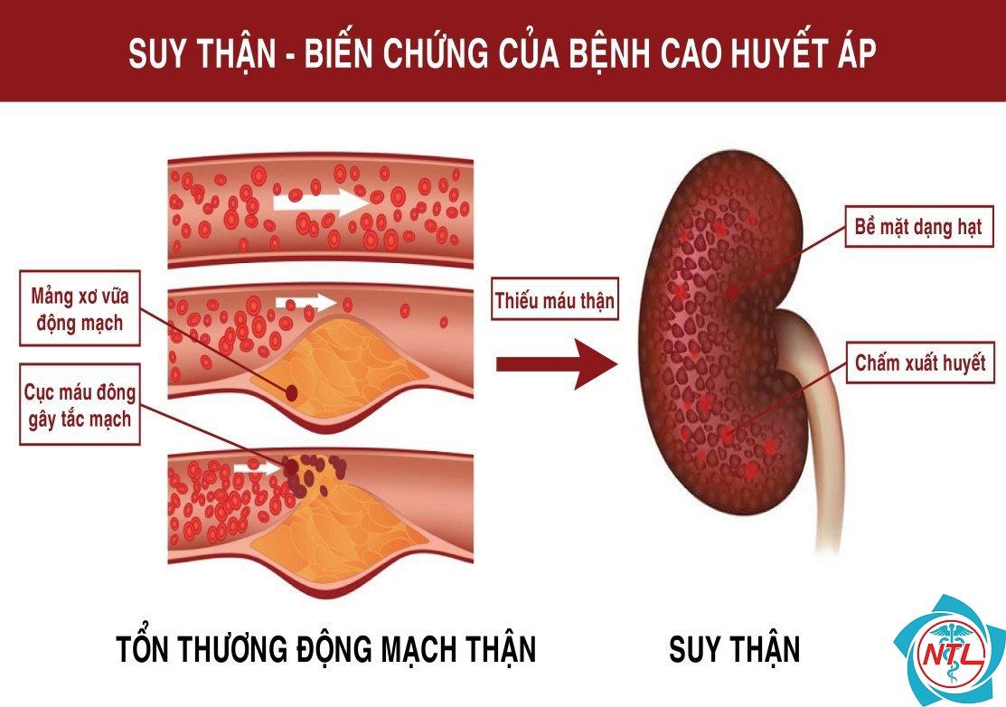 tăng huyết áp do bệnh thận - Image 1