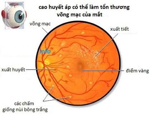 tăng huyết áp kèm hoa mắt - Image 2