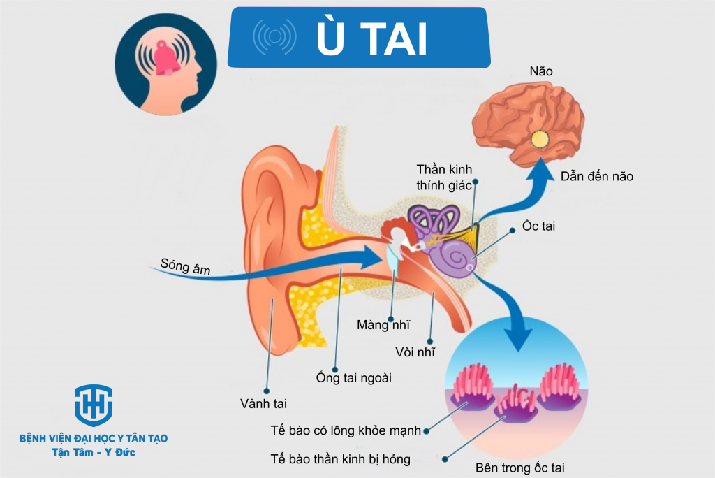 tăng huyết áp kèm ù tai - Image 4