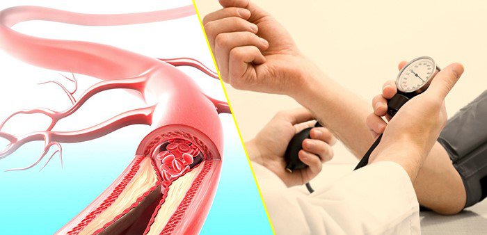 tăng huyết áp và suy tim ở người cao tuổi - Image 3
